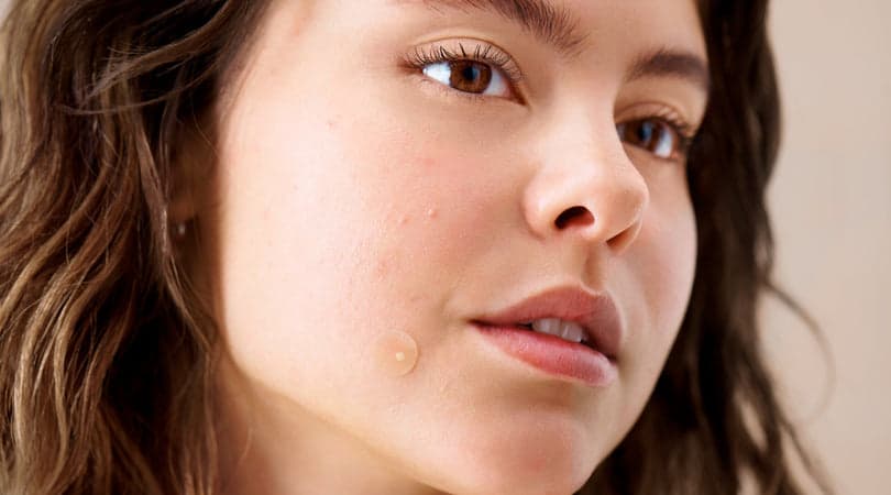 Pimples, Explained: How to Identify and Treat Every Type of Acne